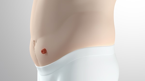 Der Bereich rund um das Stoma ist auf Höhe mit dem umgebenden Bauch