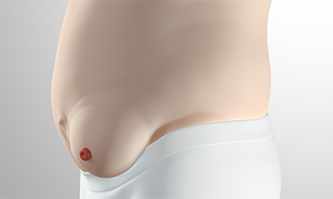 Nach außen gewölbtes Urostoma