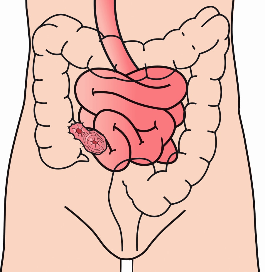 Beim doppelläufigen Ileostoma, auch Loop-Ileostomie genannt, sind zwei Darmöffnungen vorhanden