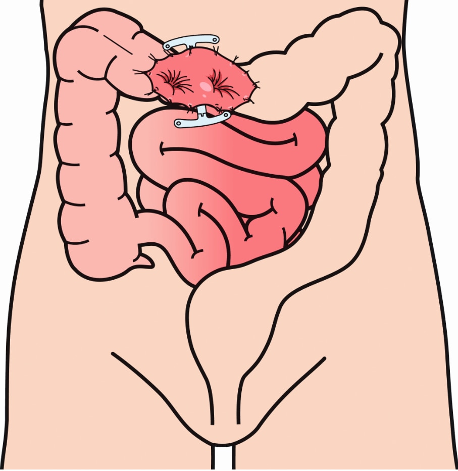 Bei einem doppelläufigen Kolostoma sind zwei Darmöffnungen vorhanden