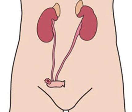 Ein Urostoma wird angelegt, wenn das harnableitende System aufgrund von geschädigten oder stillgelegten Harnwegen nicht mehr in der Lage ist, den Urin selbstständig nach außen abzugeben