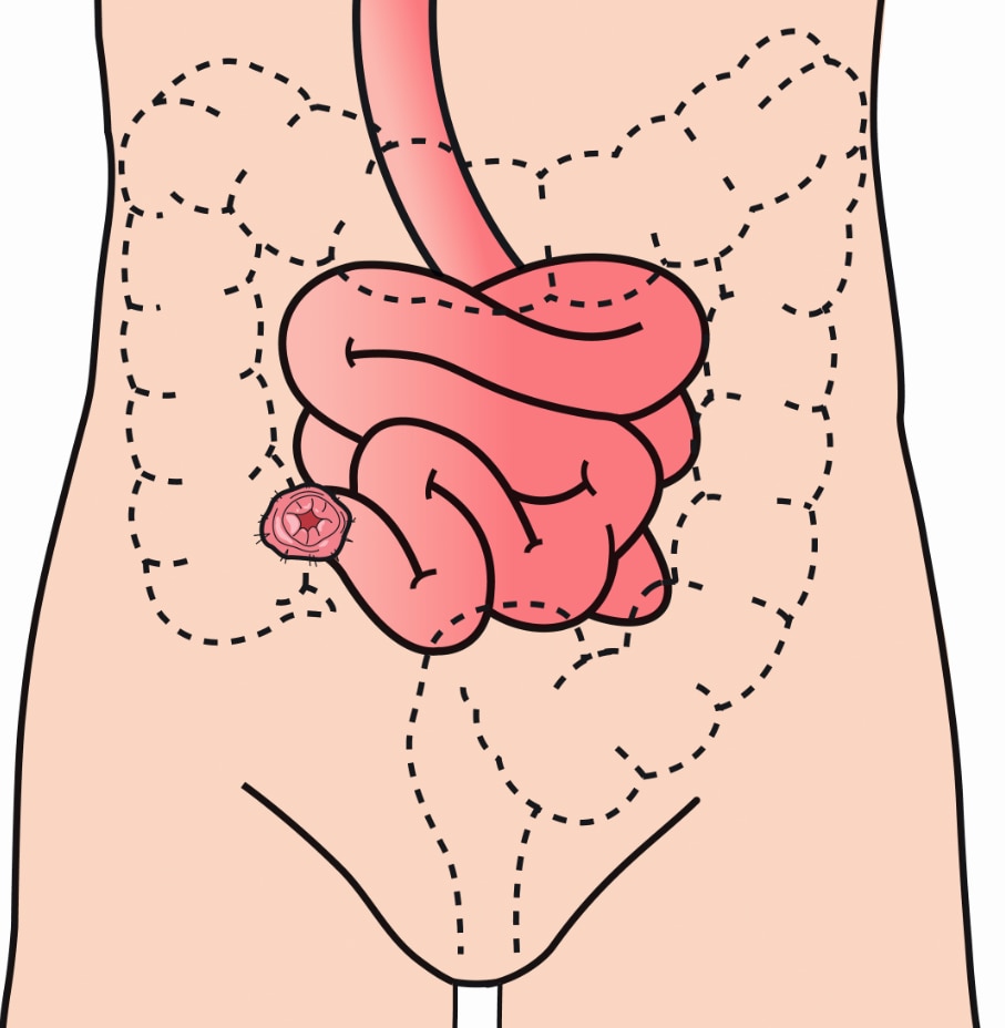 Ein Ileostoma wird angelegt, wenn ein Teil des Dickdarmes (Kolon) entfernt wird oder dieser entlastet werden muss