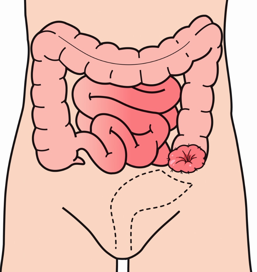 Ein Kolostoma wird aus einem Teil des Dickdarms angelegt und meist links vom Nabel platziert